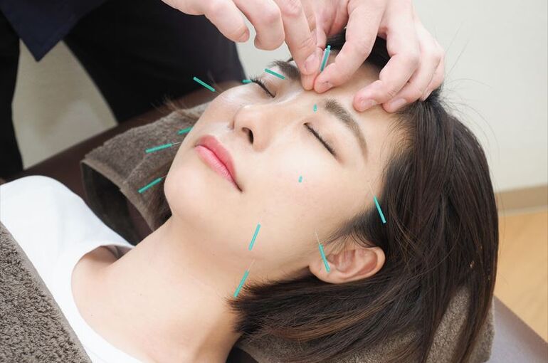 美容鍼はどんな効果があるの？